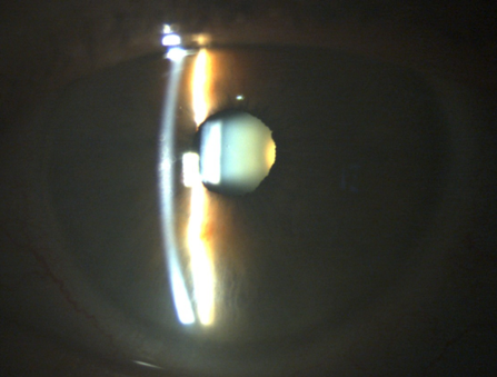 Exemple de cataracte photographiée