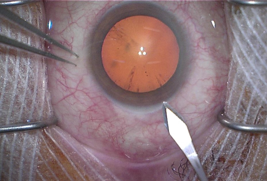 Incision chirurgie de la cataracte