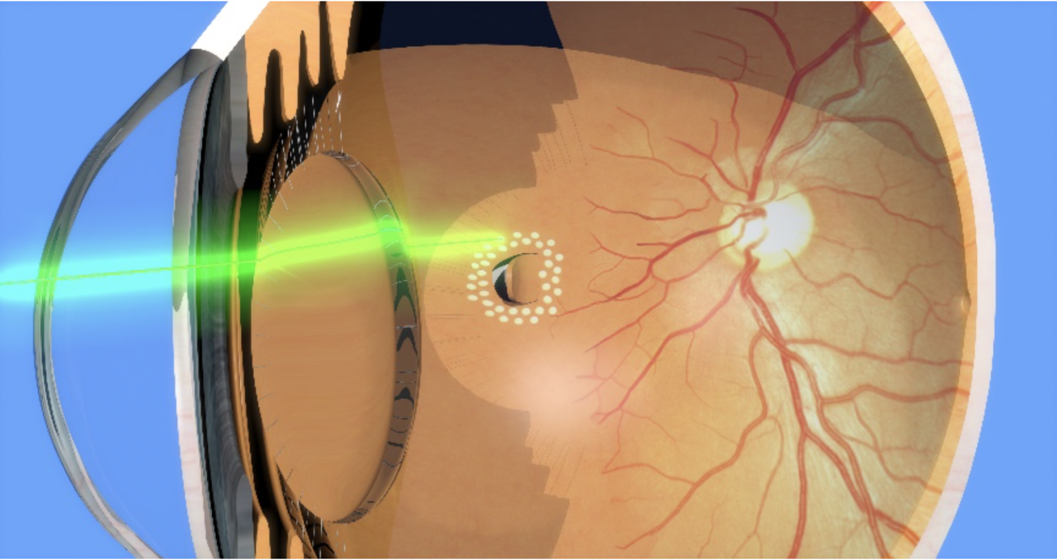 hole in retina repair