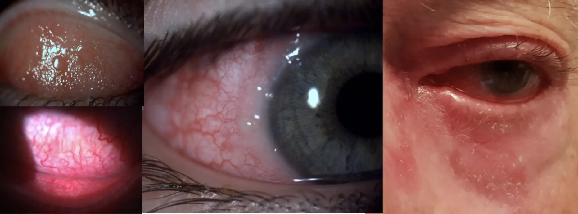Les allergies oculaires - Chirurgie Ophtalmologie Paris