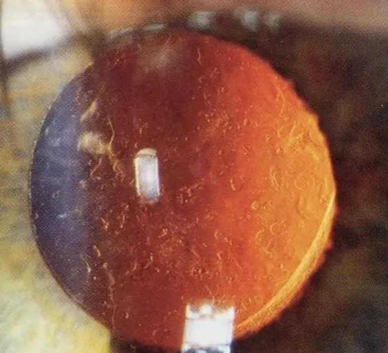 Capsule postérieure, siège d’une prolifération cellulaire, c’est ce que l’on nomme injustement « cataracte secondaire ».