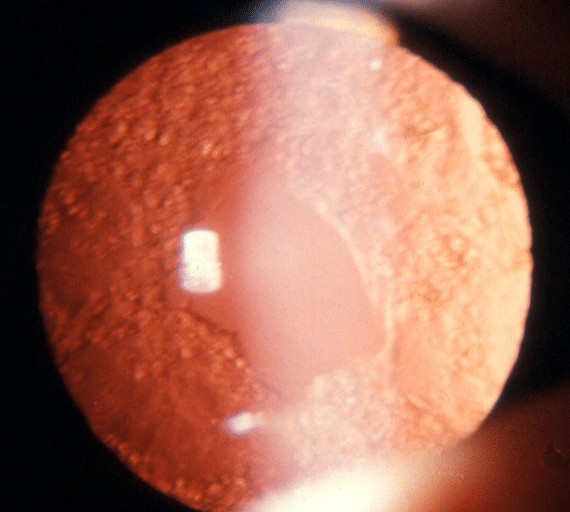 Capsule postérieure ouverte après la capsulotomie, dégageant ainsi l’axe visuel (@AAO).