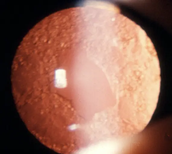 Capsule postérieure ouverte après la capsulotomie, dégageant ainsi l’axe visuel (@AAO).