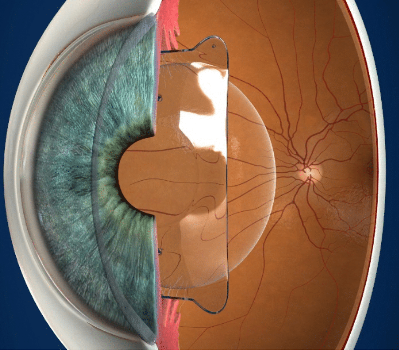 FAQ Chirurgie réfractive Chirurgie Ophtalmologie Paris Dr Blumen Ohana