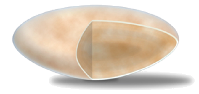 Cristallin opacifié, jauni, avec cataracte
