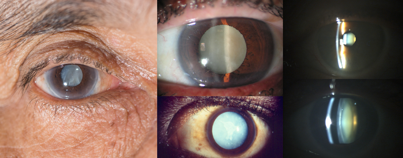 Exemples de cataracte